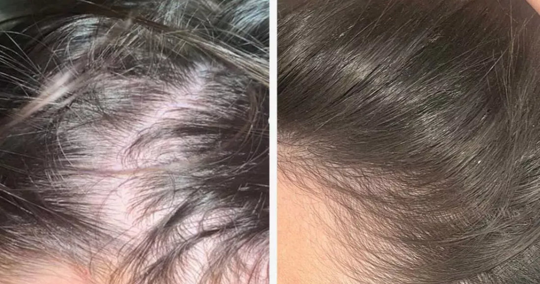 Before and after images showing a woman's thinning hair and improved hair density