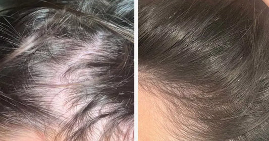 Before and after images showing a woman's thinning hair and improved hair density