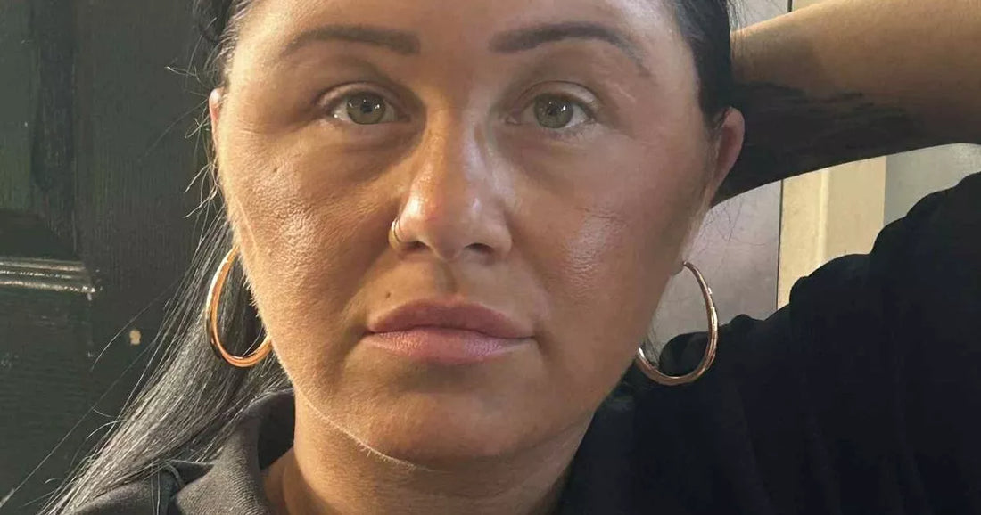 Woman showing severe facial swelling after an allergic hair dye reaction