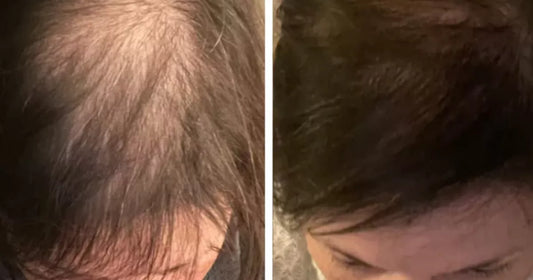 Before and after showing improved hair density in a midlife woman
