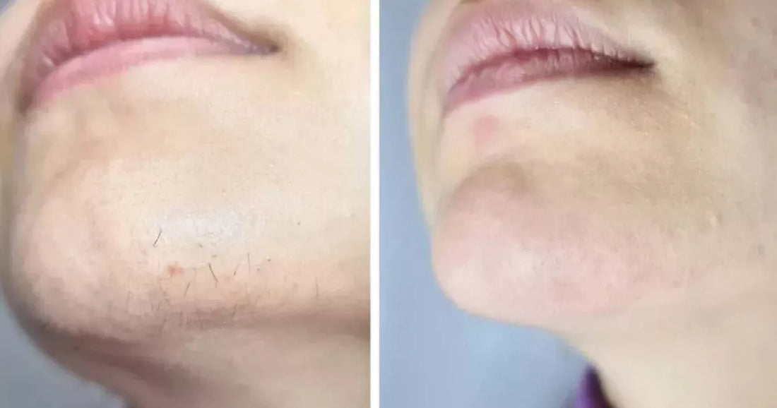 Before-and-after results image for an IPL hair removal handset