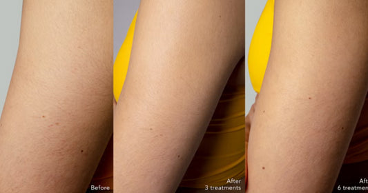 At‑home IPL hair removal device being used on a woman’s leg