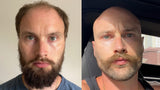 Before-and-after photos showing a man embracing hair loss with a shaved head