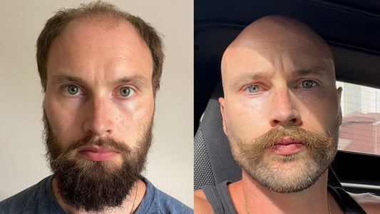 Before-and-after photos showing a man embracing hair loss with a shaved head