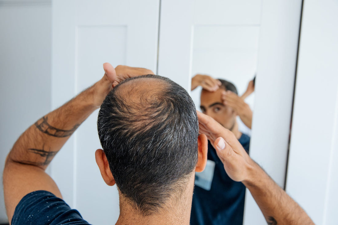 Person examining hairline in a mirror, illustrating pattern hair loss