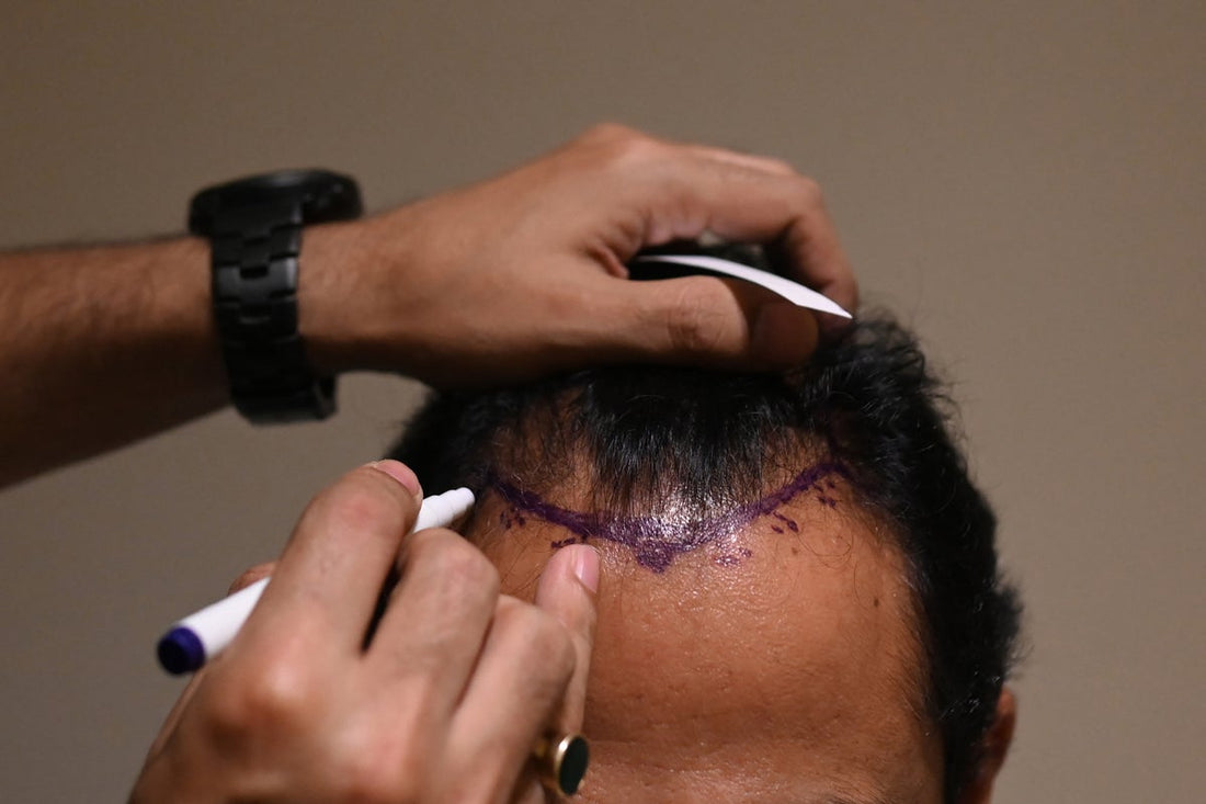 Doctor marking the scalp of a hair transplant patient ahead of a hair restoration procedure