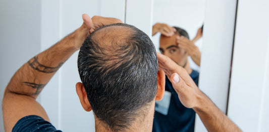Person with thinning hair, representing hair-loss and finasteride treatment